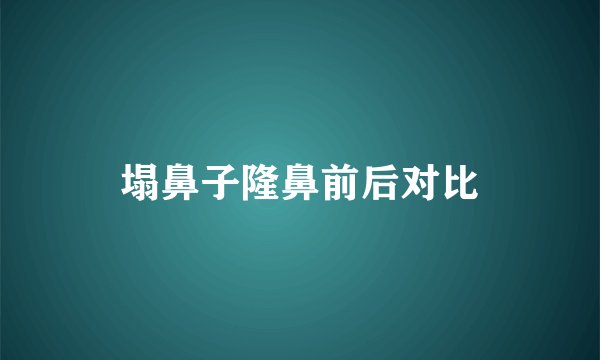 塌鼻子隆鼻前后对比