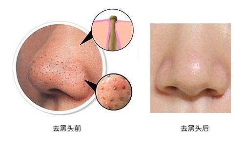 光子嫩肤去黑头的价格是多少