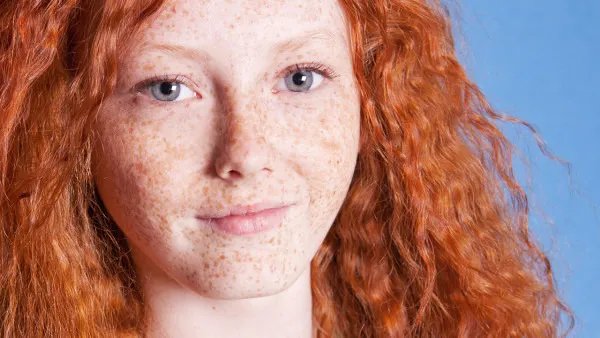 激光祛斑后会复发吗