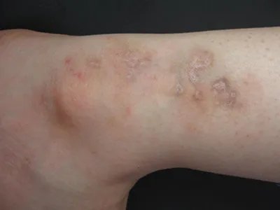 Pasini-Pierni进行性特发性皮肤萎缩红斑图片