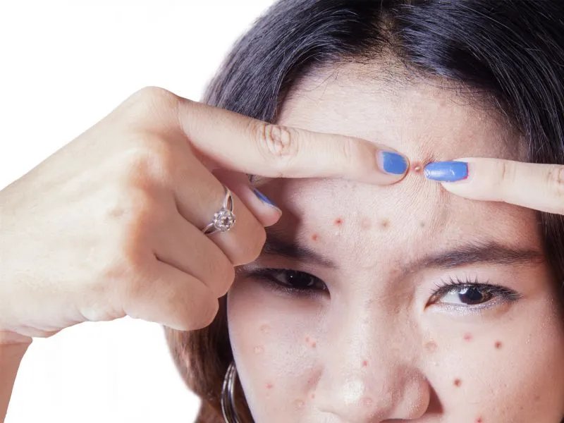 激光除痘疤的效果