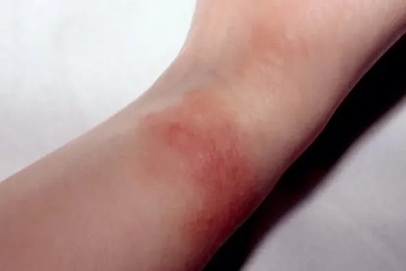 银手镯过敏皮疹图片