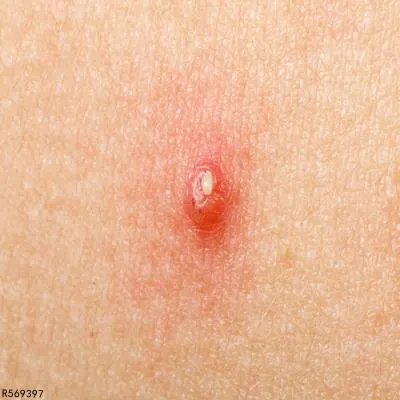 祛痘饮食如何调理 教你摆脱痘痘的法宝