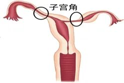 子宫角的位置示意图