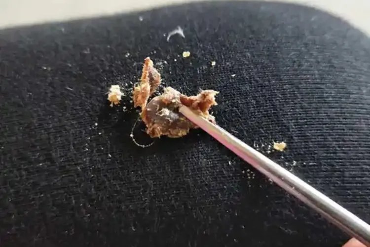 婴儿掉出来黑色耳屎图片