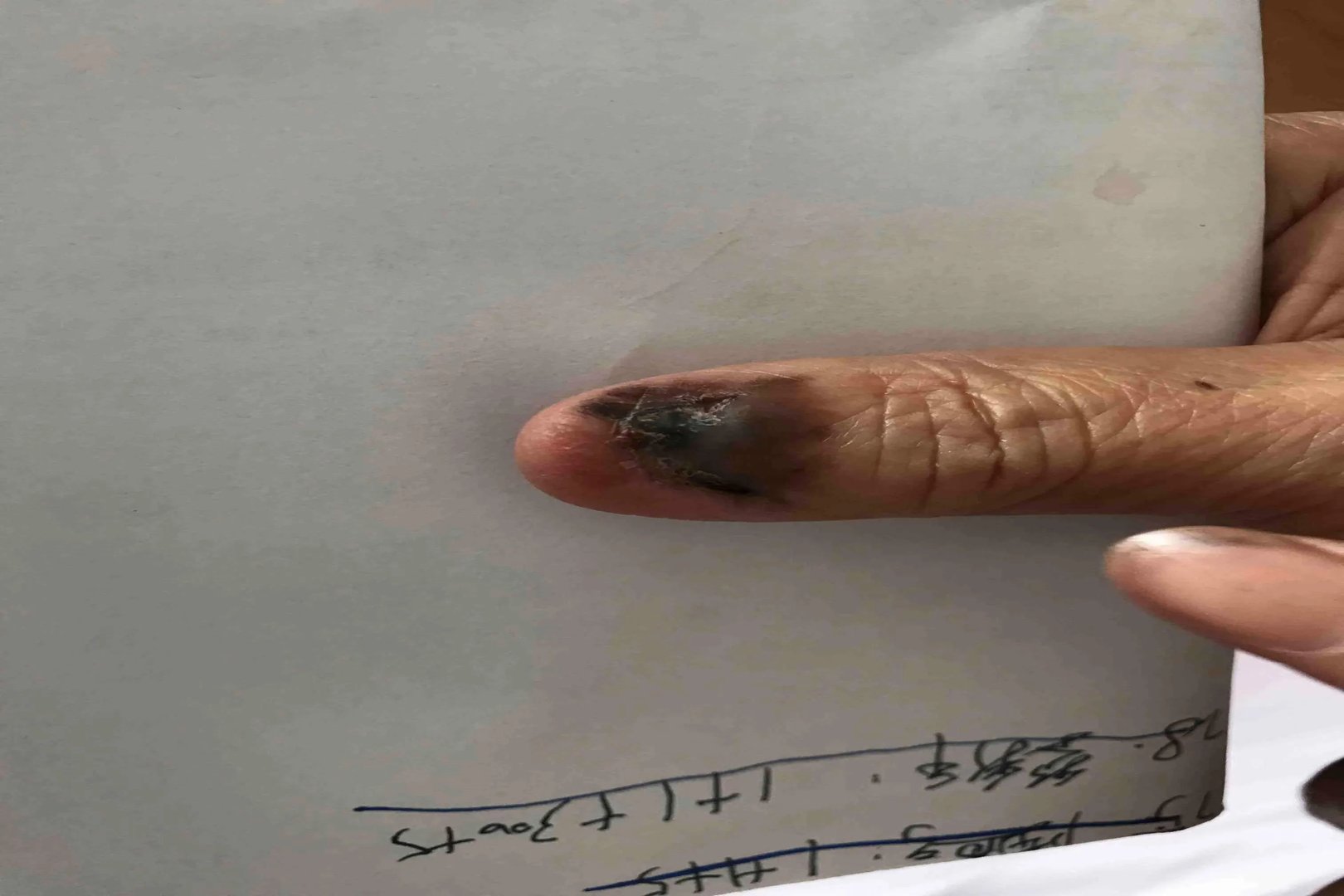 手指黑色素瘤图片