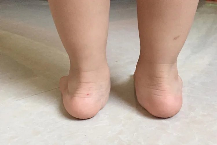 脚踝往里歪图片