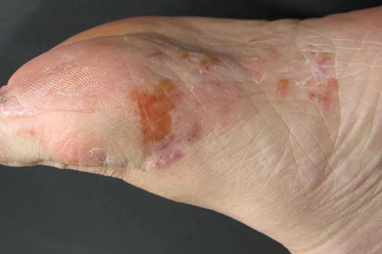 癣的种类与辨别图片