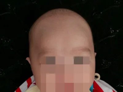 新生儿佝偻病症状图片