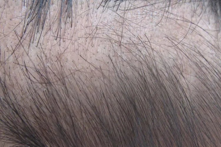 癣的种类与辨别图片