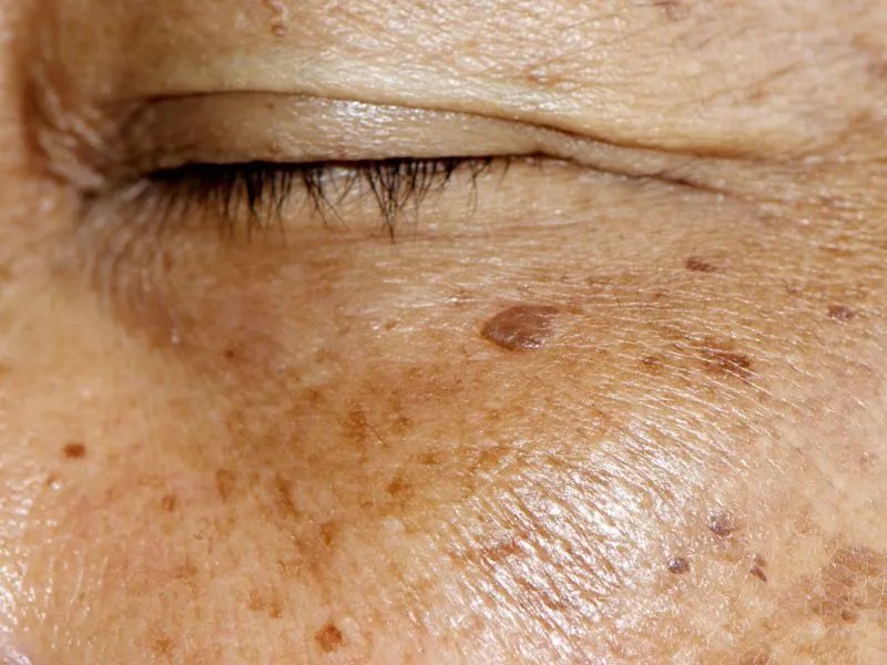 减少老年斑的方法