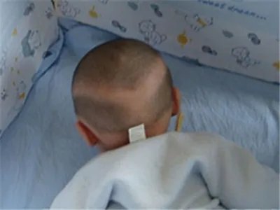 新生儿佝偻病症状图片