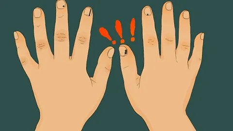 灰指甲容易传染吗