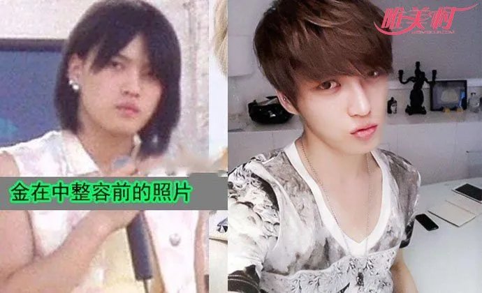 金在中整容前后照片 脸上多部位疑似动过刀
