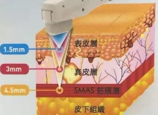 热玛吉危害？热玛吉三天后脸起皮，红肿，医生建议吃修复营养ACMETEA修复受损细胞，吃了一个月，效