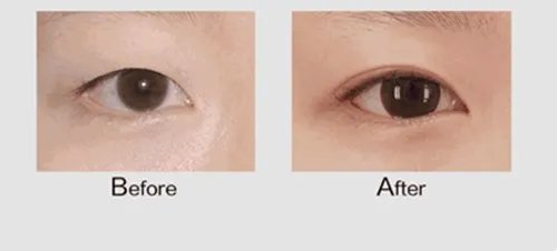 开眼角手术过程是怎样的？