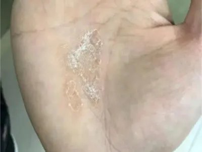 掌黑癣脱皮图片