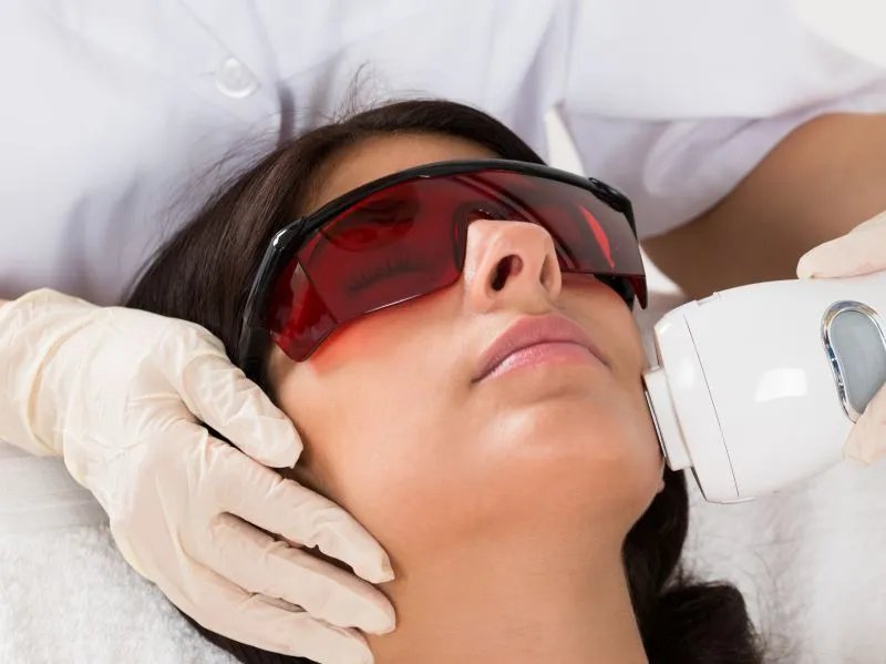 激光手术治疗痘坑