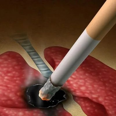 肺癌手术后复发的症状