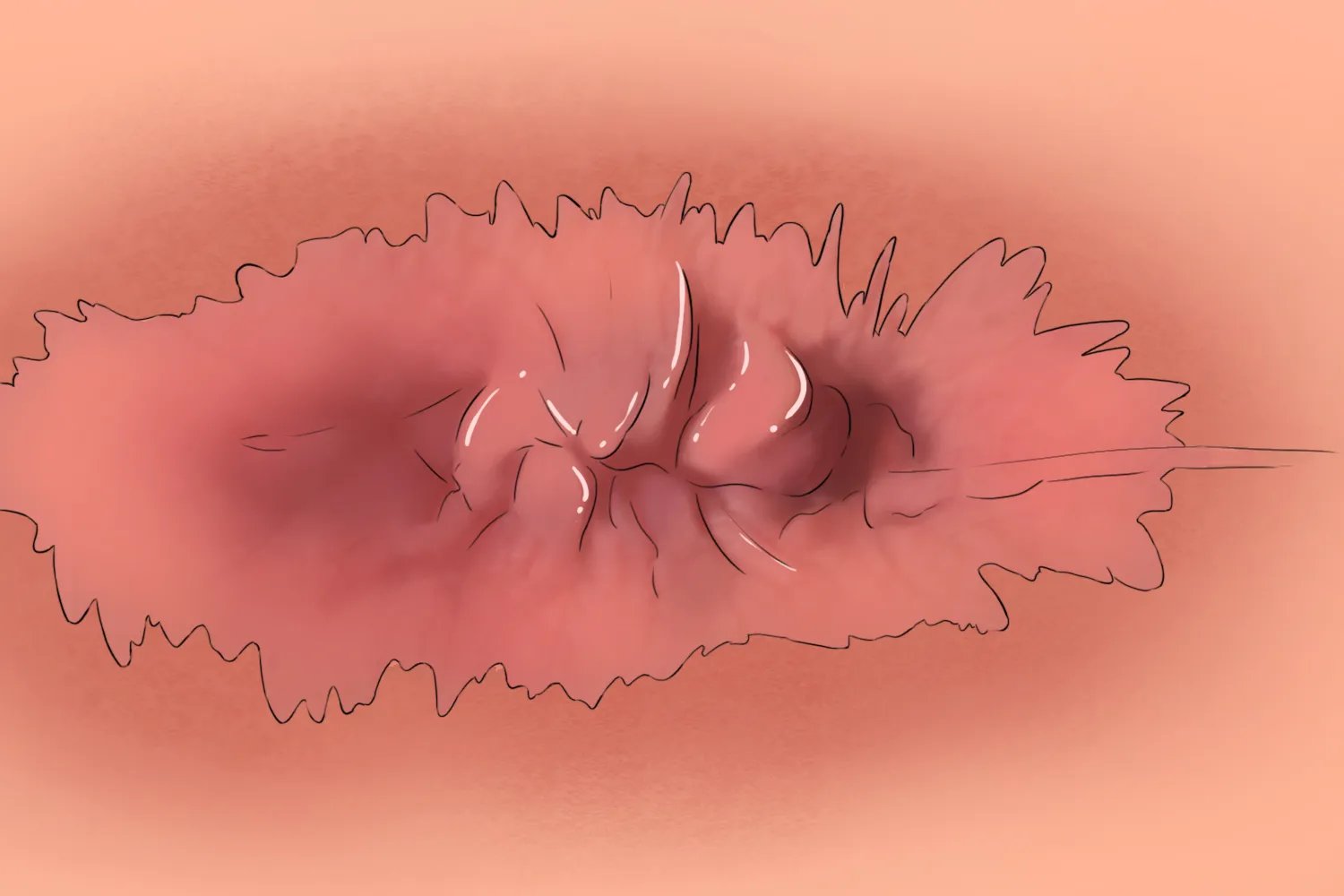 肛门脱落什么症状图片