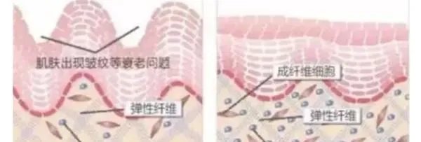 热玛吉危害？热玛吉三天后脸起皮，红肿，医生建议吃修复营养ACMETEA修复受损细胞，吃了一个月，效