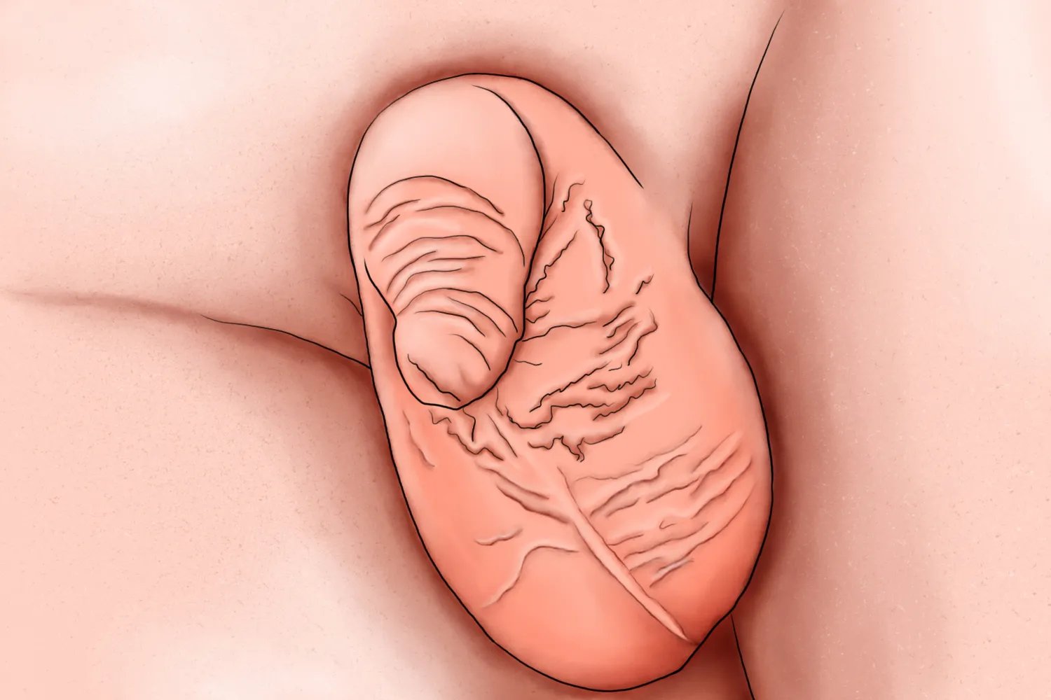 包茎的症状图片