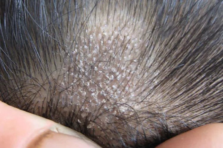 癣的种类与辨别图片