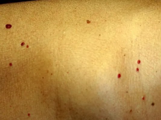 痣里长毛的原因