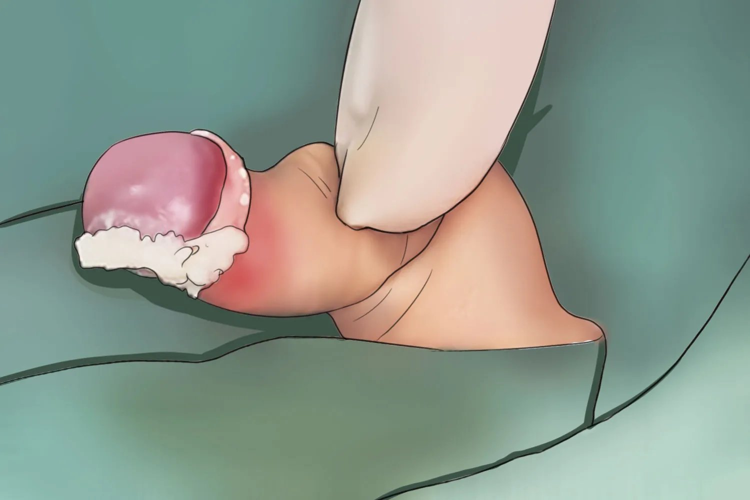 包茎的症状图片