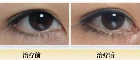 开眼角手术过程是怎样的？