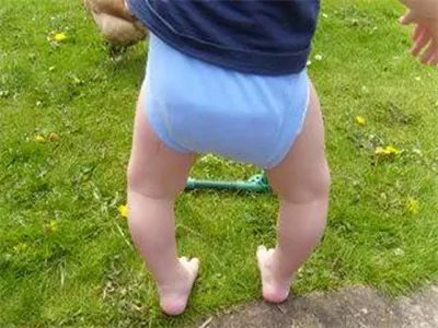 新生儿佝偻病症状图片