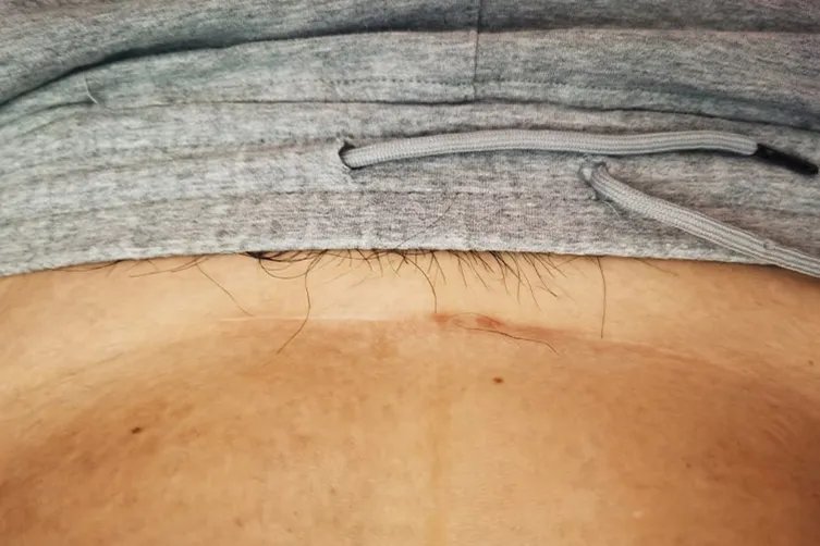 剖腹产一年后正常疤痕图片