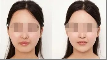 垫下巴术要多少钱