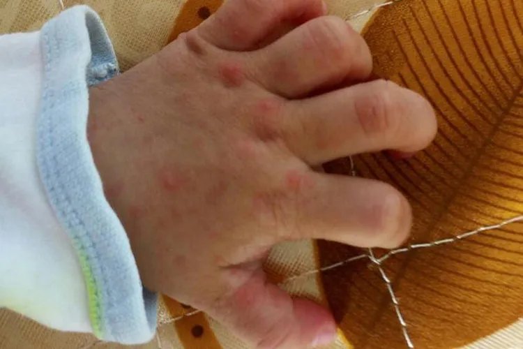 婴儿常见皮肤病配图