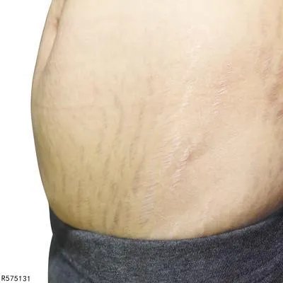 产后妊娠纹该如何祛除 产后妊娠纹的四个去除技巧分享