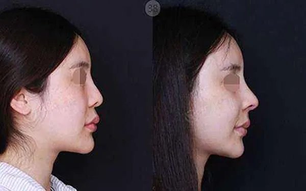 北京假体隆鼻哪家医院好