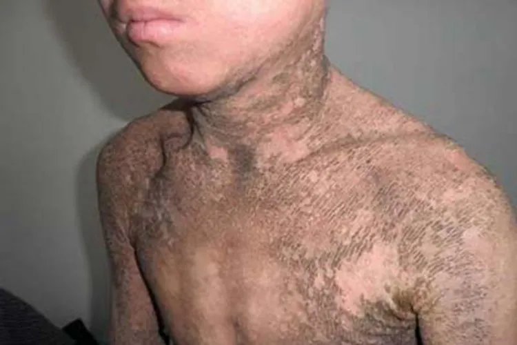 X连锁鱼鳞病全身症状图片