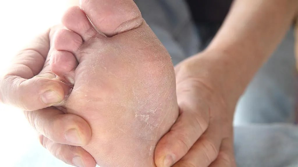 脚气的症状是什么?轻微脚气的症状图片