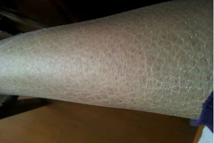 腿上有鱼鳞图片