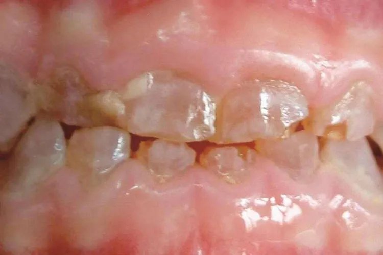 遗传性乳光牙本质图片