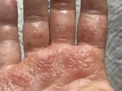 手部湿疹手掌水疱图片