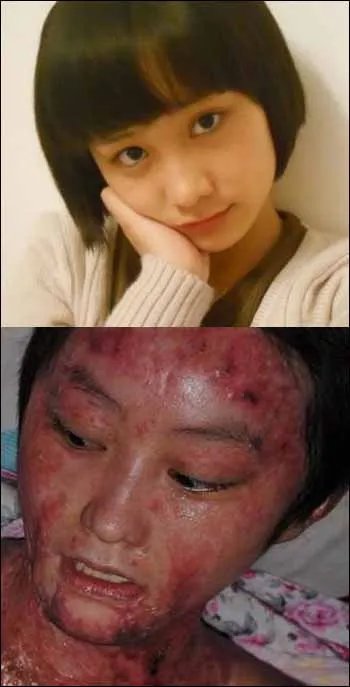 合肥少女毁容案的事件经过