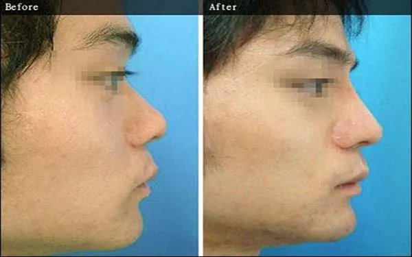 北京假体隆鼻哪家医院好