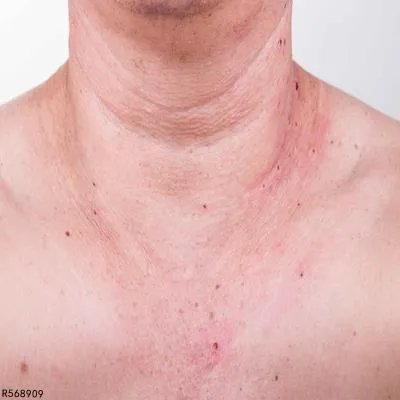 脖子上的皱纹怎样去掉