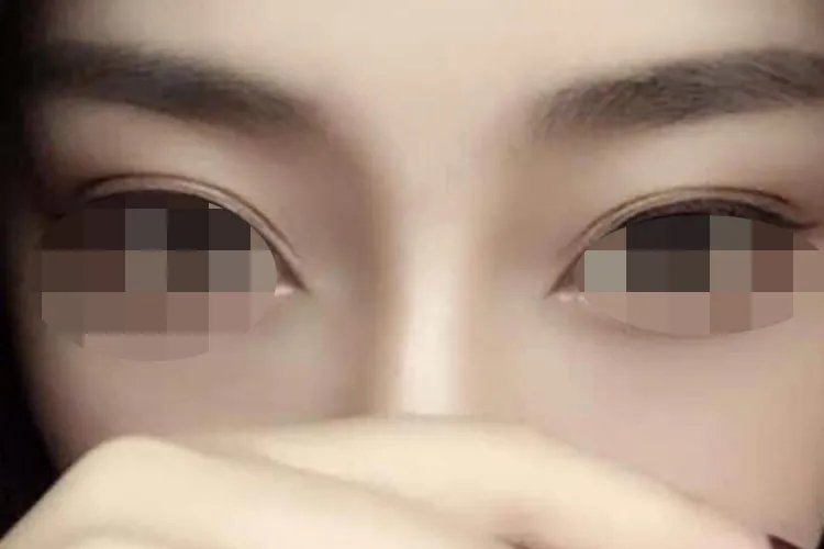 双眼皮类型及图片大全