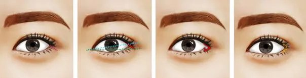 眼角提升手术的方法是什么?