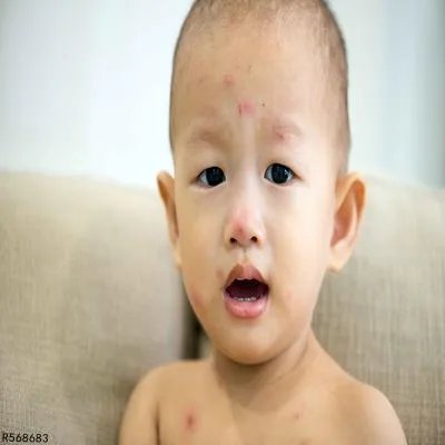 怎样接种麻疹疫苗