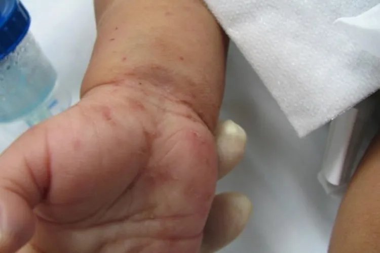 皮肤病疥疮是什么症状图片