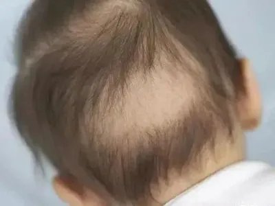 新生儿佝偻病症状图片