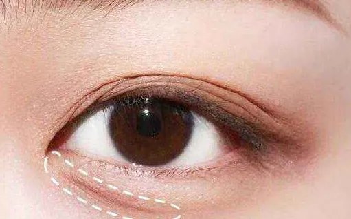 韩式开眼角的效果好吗